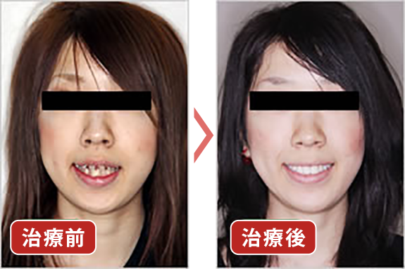 治療前　治療後