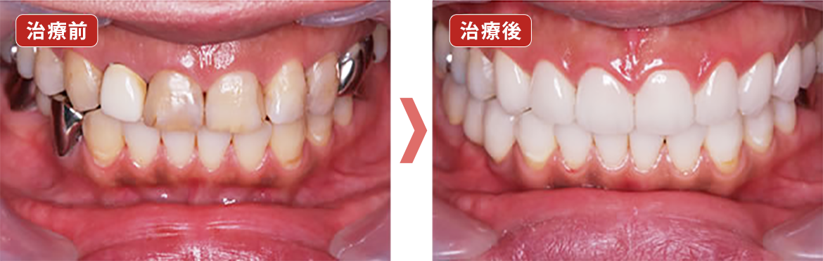 治療前　治療後