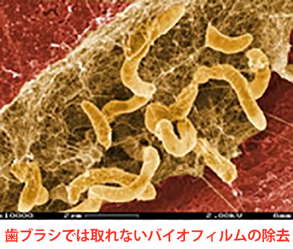 歯ブラシでは取れないバイオフィルムの除去
