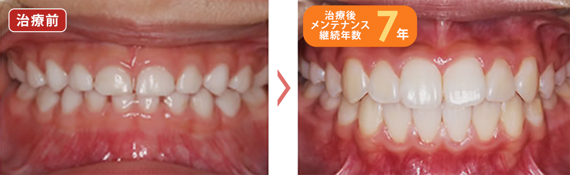 3歳～定期的メンテナンス（PMTC + フッ素）のみ　3ヶ月毎