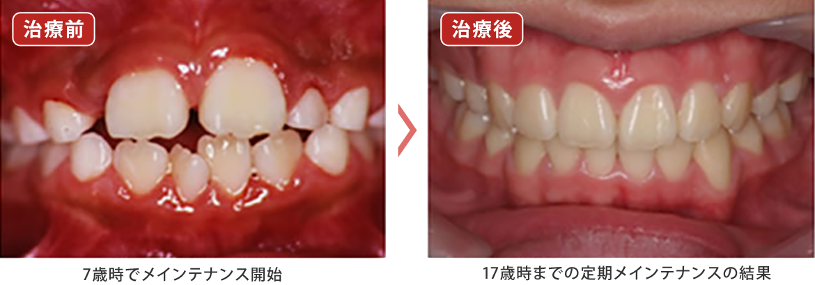 7～17歳 矯正 + 定期的メンテナンス（PMTC + フッ素）3ヶ月毎