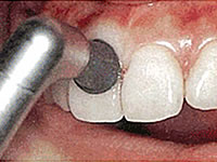 歯肉を傷つけないように、柔らかいラバーカップで歯と歯肉の境目の汚れを落とします。