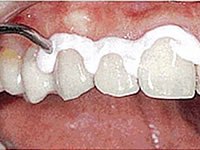 歯の表面に専用のクリーニングペーストを塗ります。