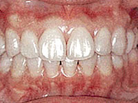 歯の質を強くし輝きを増すために、きれいになった歯面にフッ素を塗布して終了です。