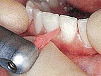 プラスチックのチップを使って歯と歯の間の汚れを落とします。