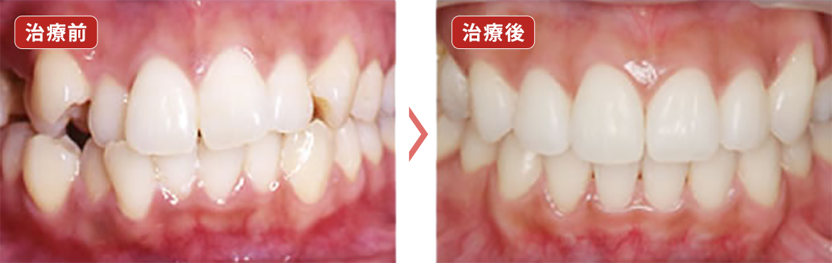 成人矯正