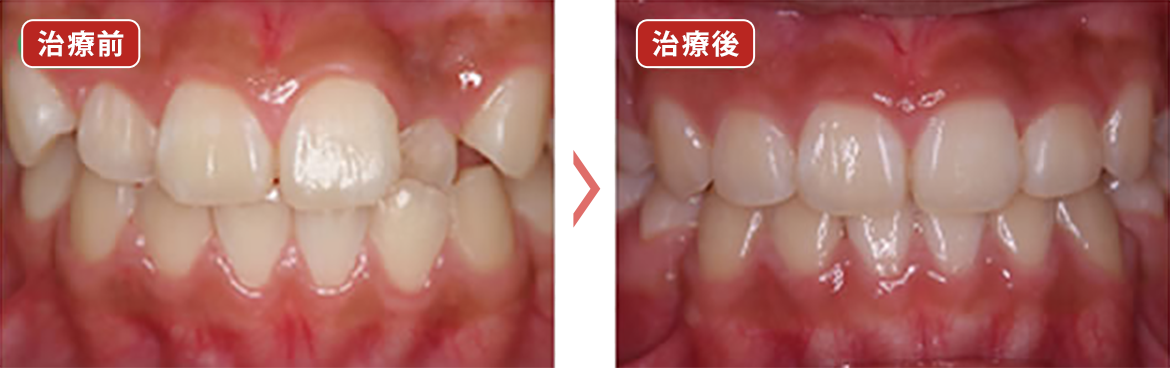 13～17歳 矯正