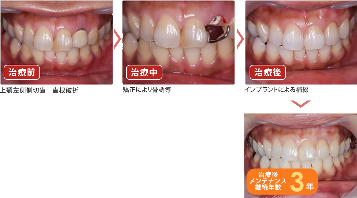 ☆小矯正　☆ホワイトニング　☆インプラント