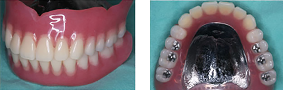 FD金属床 + レ―ビン　切削効率を良好にする人工歯