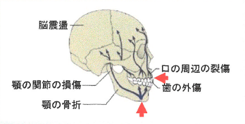 マウスガードとは